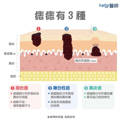 痣長白毛|痣變大、痣多或長毛會變皮膚癌？認識痣的形成與原因